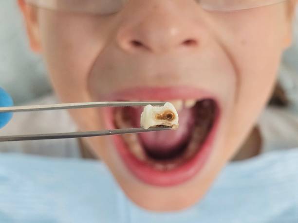 Best Broken or Cracked Tooth Emergency Dentist in Oakwood, GA
